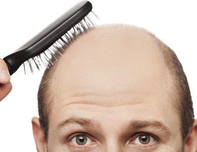 Minoxidil contra la alopecia, ¿es efectivo? - Bekia Salud