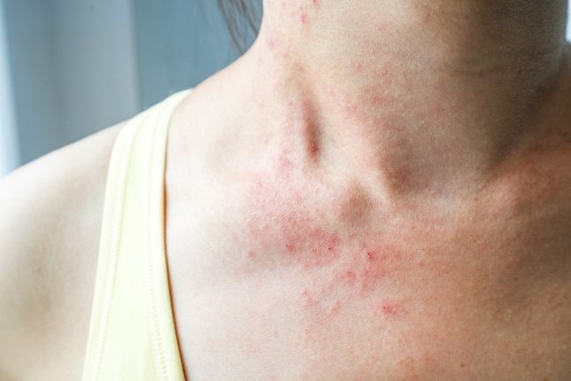 Los pacientes afectados de lupus eritematoso sistémico es común que también muestren lesiones en la piel