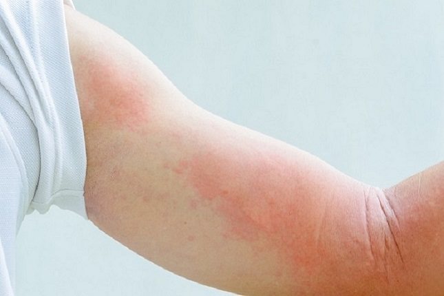 Una persona con lupus eritematoso sistémico es más sensible a las infecciones