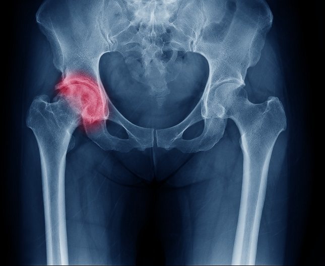 Si la cadera se fractura, es posible que la persona sufra un fuerte dolor en la zona de la ingle