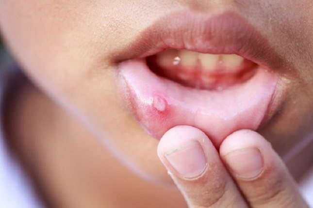 El herpes labial es un tipo de virus bastante frecuente en la población mundial