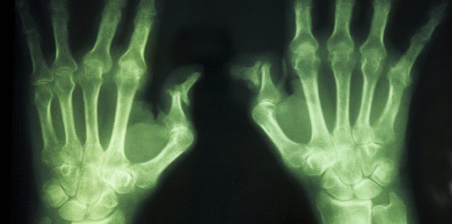 Una simple radiografía permite diagnosticar la artrosis