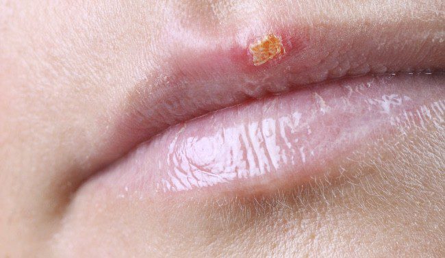 El herpes labial suele ser altamente contagioso