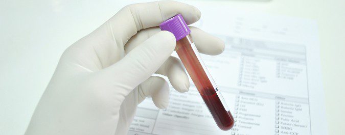 Un análisis de sangre puede indicarnos que debemos realizar una exploración para detectar cáncer de próstata