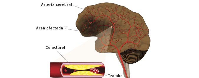 En el ictus isquémico, un trombo no deja pasar la sangre hacia el cerebro