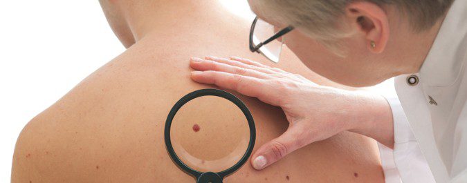 La regla ABCDE nos ayuda a identificar señales anómalas en la piel, que posteriormente consultaremos con un médico