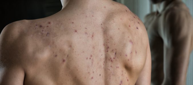 El acné en la espalda suele tener un origen hormonal