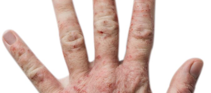  Se desconocen las causas exactas que producen la dermatitis atópica, al primer síntoma debemos acudir al dermatologo