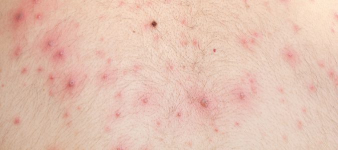  Uno de los principales síntomas de la varicela es la aparición de granos.