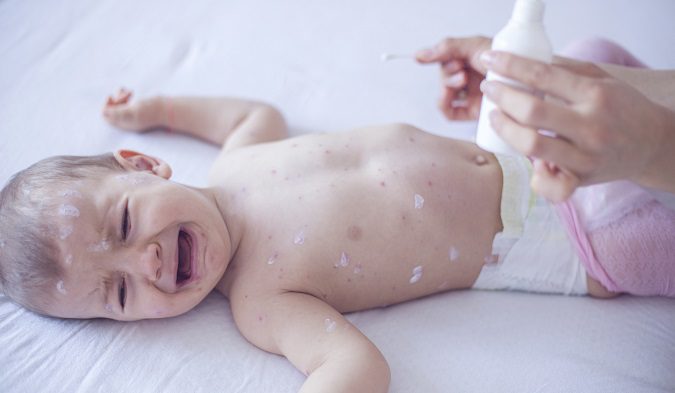 La varicela es una enfermedad que aparece tanto en niños como en adultos