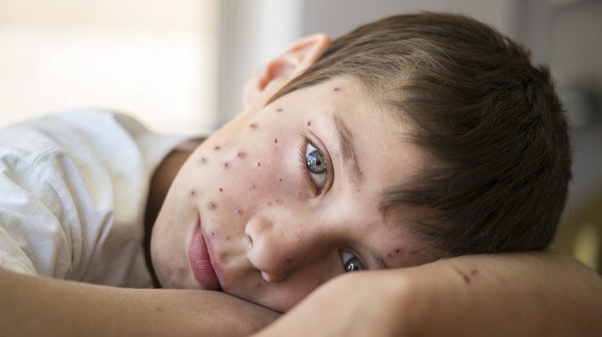 La varicela es una enfermedad viral extremadamente contagiosa