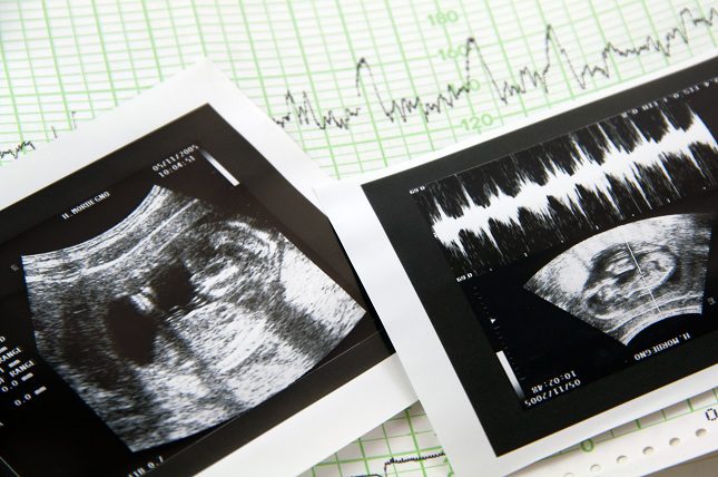 Existen factores de riesgo relacionados con sufrir un aborto involuntario