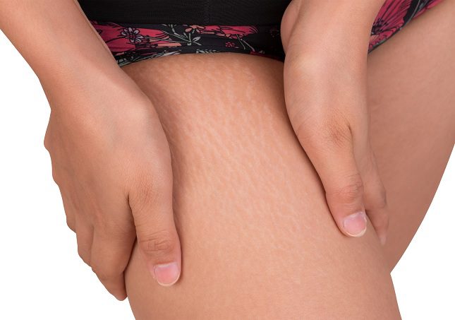 Las piernas, la barriga, los pechos y los glúteos son las zonas que normalmente se ven más afectadas por las estrías