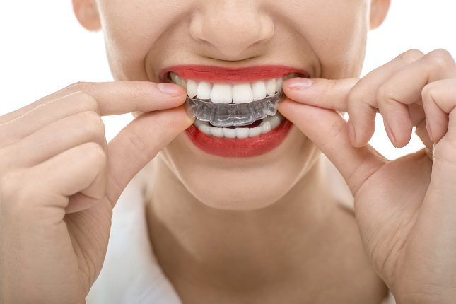  La gran diferencia entre los distintos tipos de ortodoncia son su método de funcionamiento