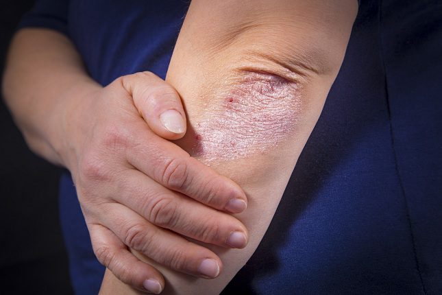 Los primeros síntomas de la alergia al sol que suelen hacer aparición son el enrojecimiento de la piel acompañado de picores y dolor
