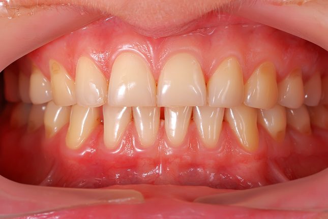 Una falta de la higiene adecuada para tener los dientes sanos también puede causar que las encías se vuelvan más oscuras