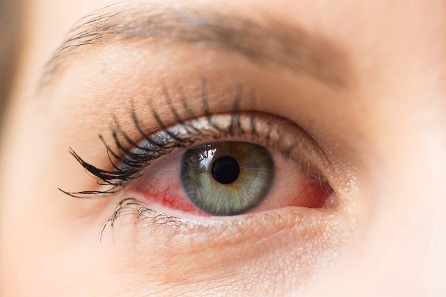 En el caso de tener conjuntivitis lo primero que hay que hacer es acudir al oftalmólogo