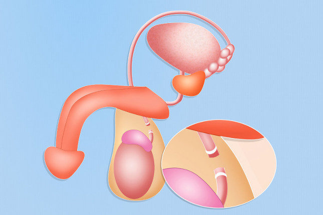 Lo que hace la vasectomía es evitar que en el semen haya espermatozoides