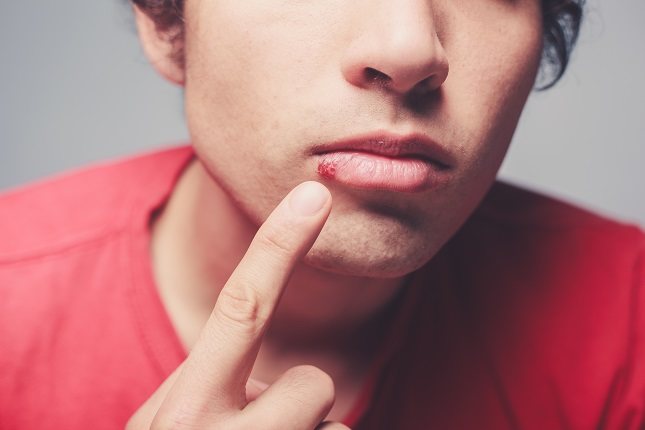 El herpes labial es una enfermedad de tipo vírica que ataca a los labios