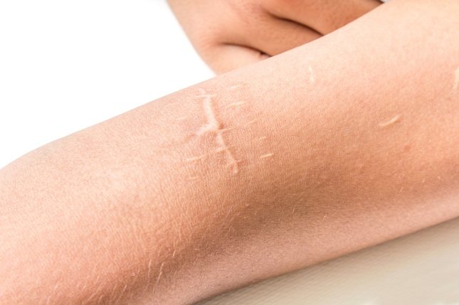 El seroma es la complicación de una cicatrización en la que hay parte del tejido de la piel que no ha llegado a cerrar bien