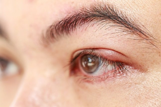 En el momento en el que alguien está sufriendo esta forma de plegarse del párpado, hay muchos síntomas que se padecen en el ojo