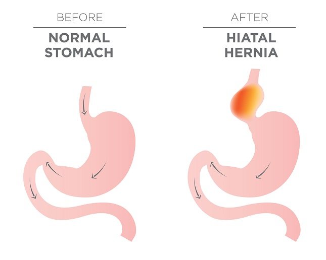 Un estómago intratorácico es una condición rara en la cual el estómago se desliza completamente en la cavidad torácica
