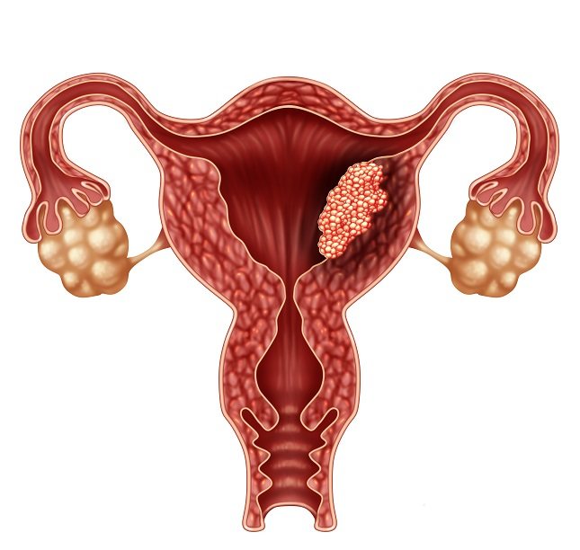 Los médicos clasifican los fibromas en función de su localización en el útero