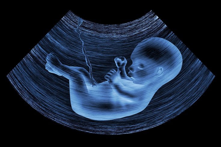 El fetus in fetu es un crecimiento benigno de origen embriológico