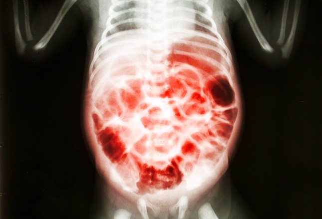 Esta enfermedad se desarrolla cuando el tejido que reviste el colon se inflama y puede llegar a morir
