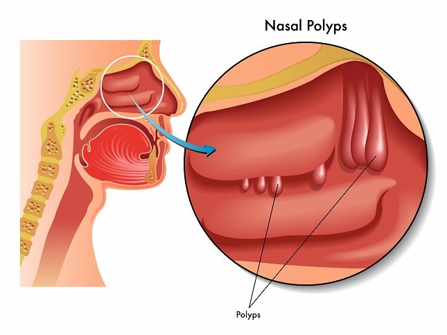 La cirugía de pólipos nasales aumenta el riesgo de un paciente de desarrollar sangrado