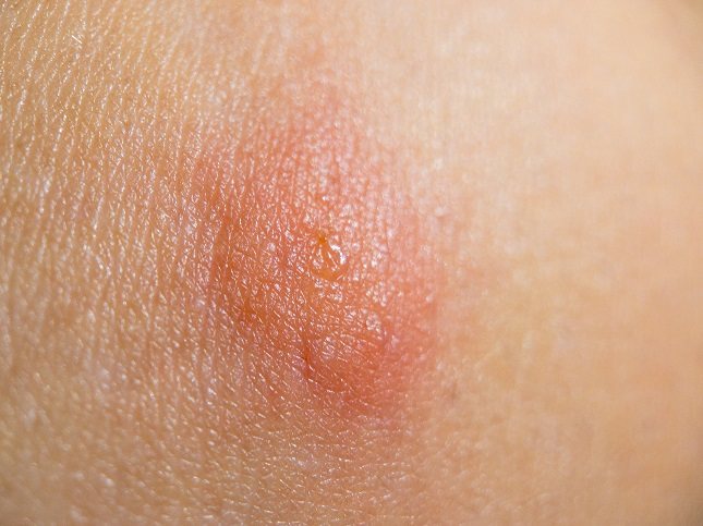 Hay muchas formas de prevenir las picaduras de pulgas