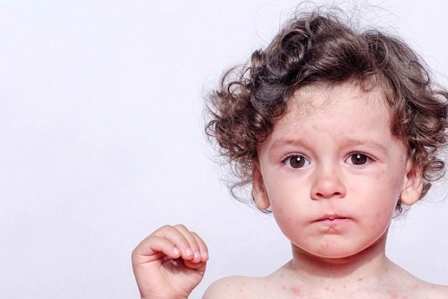 La herpangina, que generalmente afecta a niños pequeños, causa ampollas en la boca