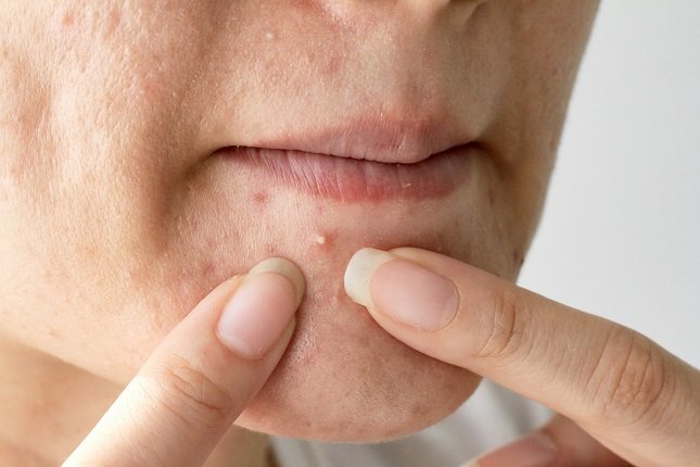 Las mujeres adultas que tienen acné de manera persistente pueden pasarlo bastante mal