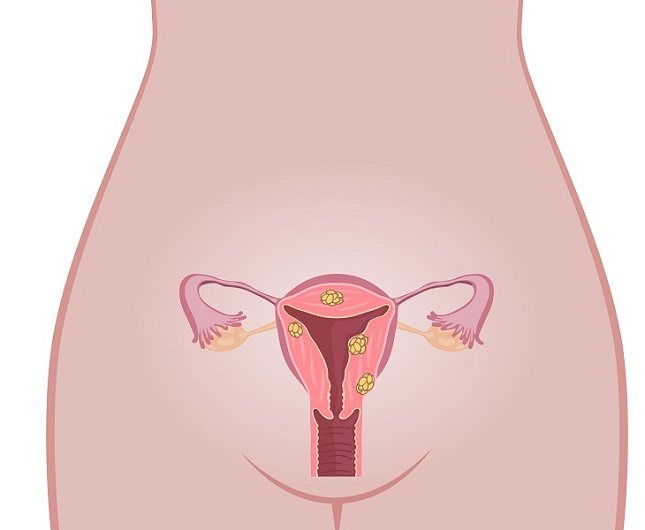 Durante una biopsia endometrial, una mujer puede experimentar calambres leves