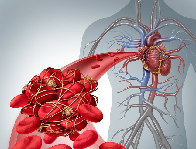 Un tromboembolismo venoso puede ocurrir si el flujo sanguíneo cambia