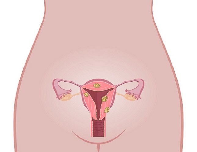 Los fibromas son crecimientos en el útero