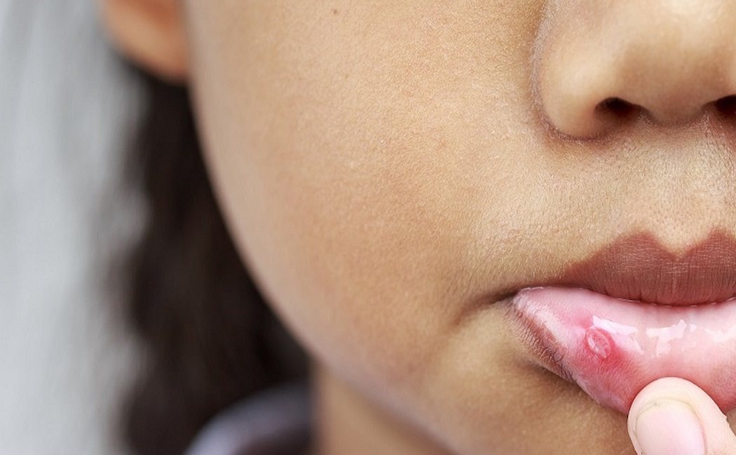 Las 3 causas principales por las que se produce el herpes labial