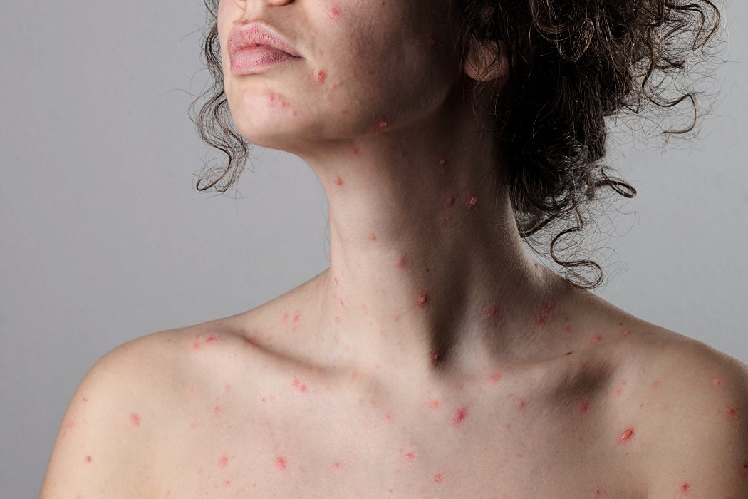 La varicela en adultos