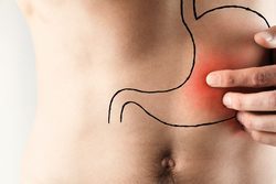 Úlcera de estómago, síntomas y tratamiento