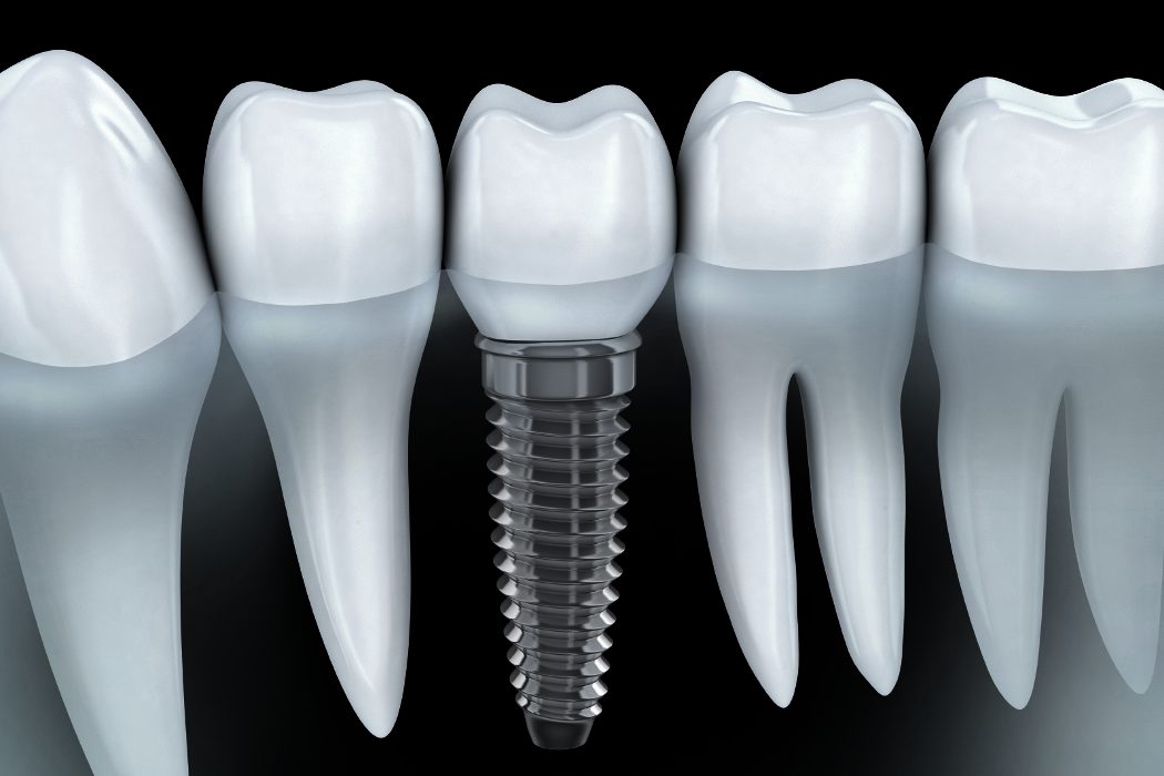 ¿Cuándo es necesario recurrir a los implantes dentales?
