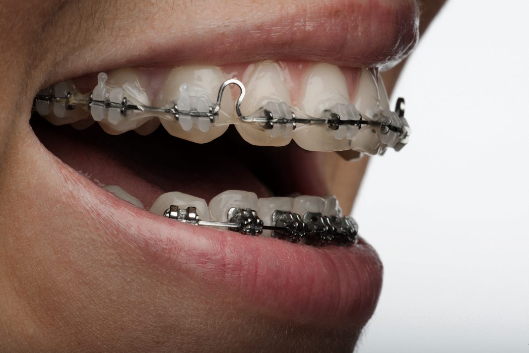 Ortodoncia: ¿en qué consiste?