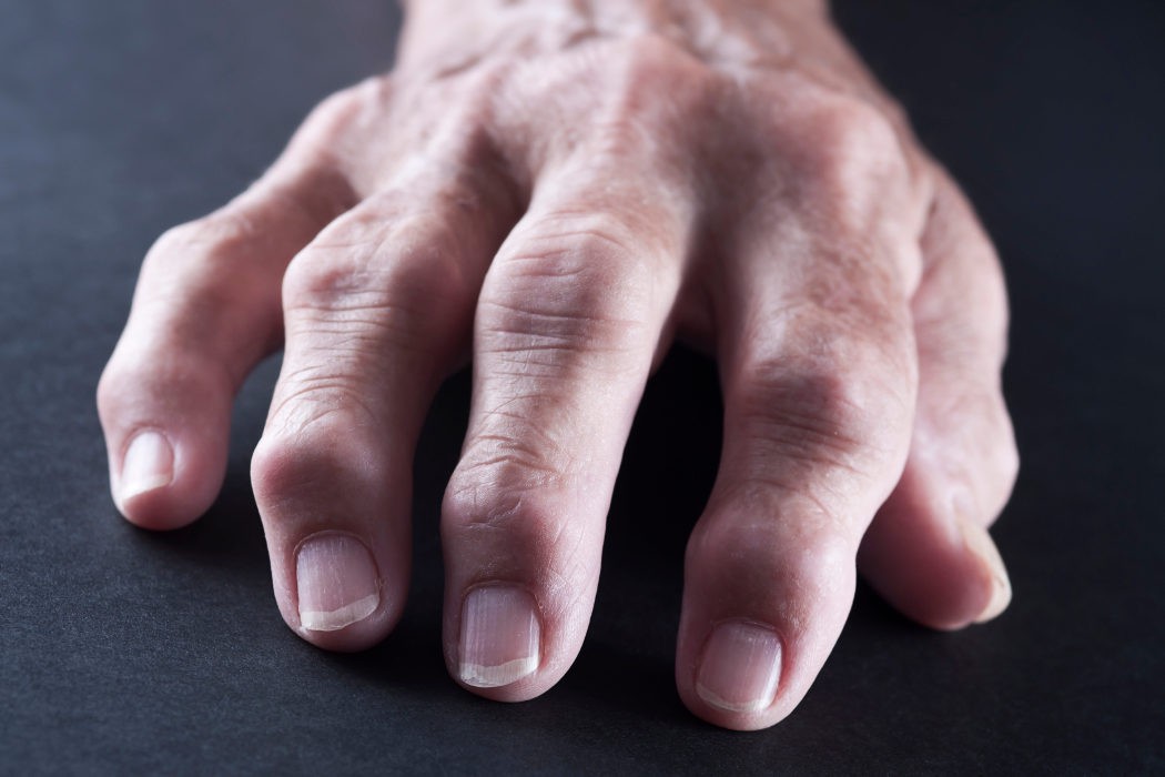 ¿Es lo mismo la artrosis que la artritis?