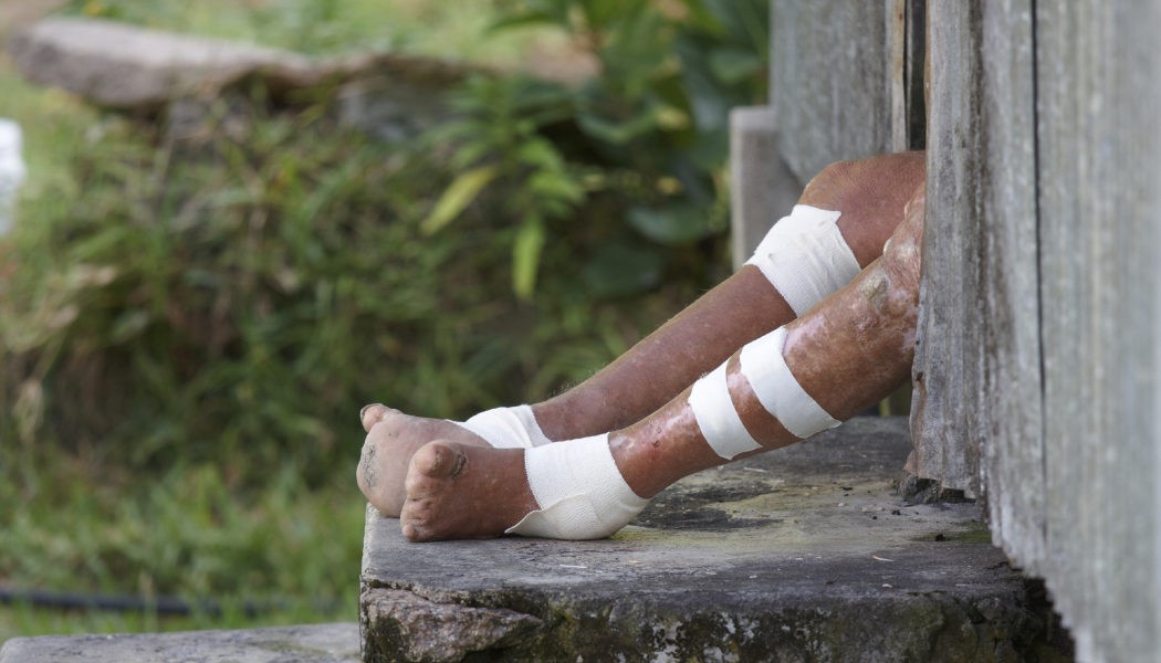 Día Mundial contra la Lepra: ¿Cuáles son los síntomas de esta enfermedad?