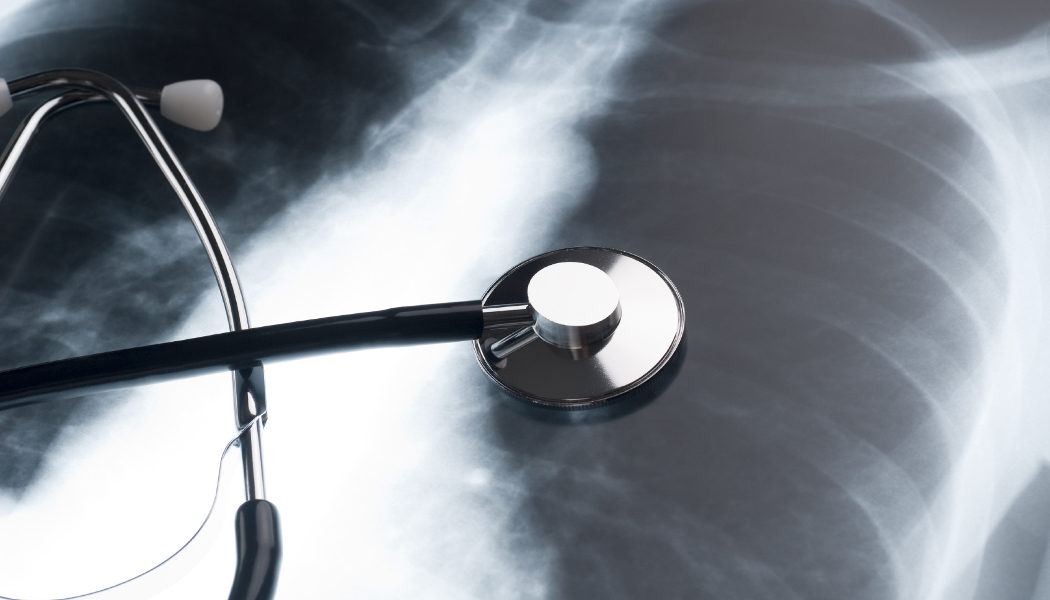 Causas y síntomas de la fibrosis pulmonar