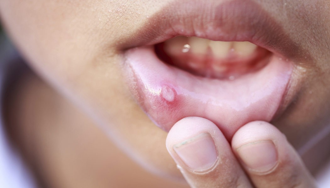 Aftas, llagas y úlceras bucales: remedios naturales para curarlas