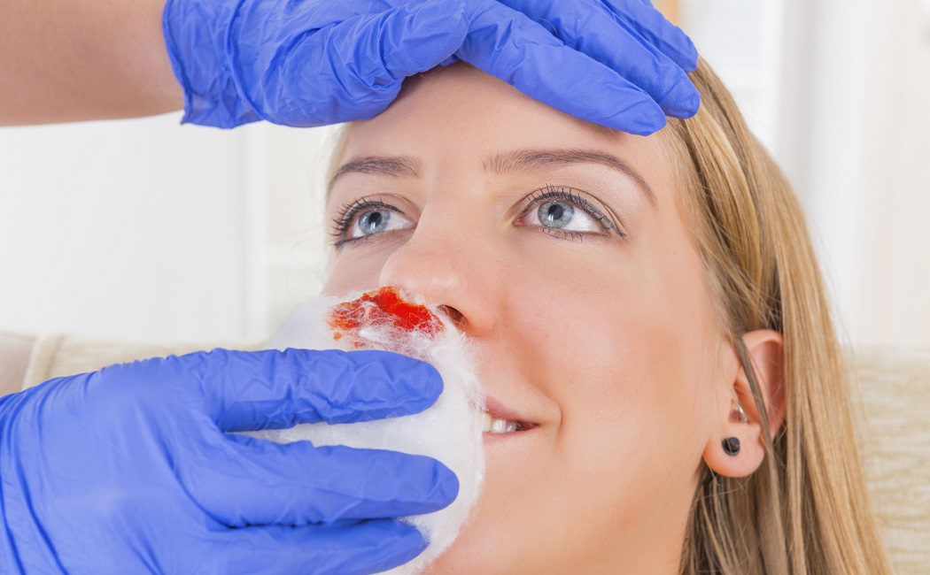 Qué hacer cuando te sangra la nariz