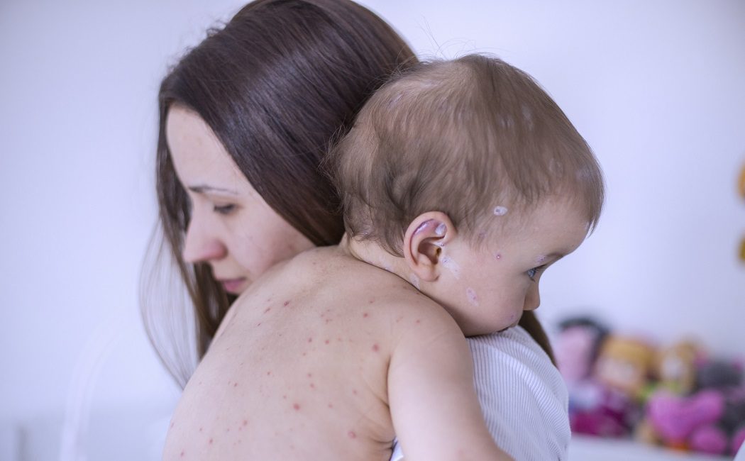 La varicela en bebés