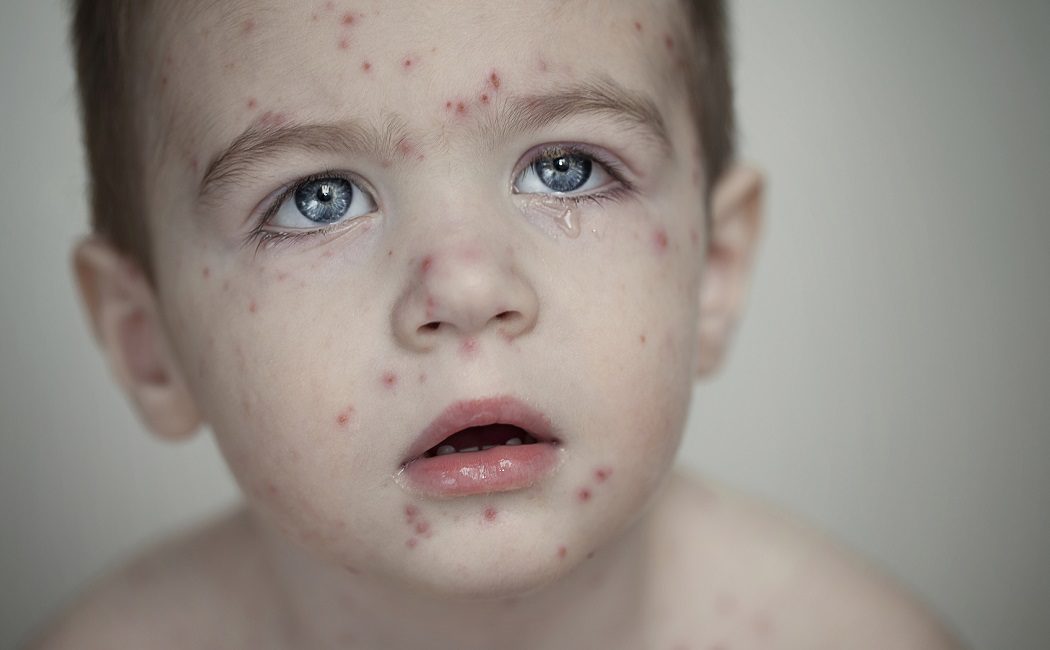 La varicela en niños: todo lo que debes saber