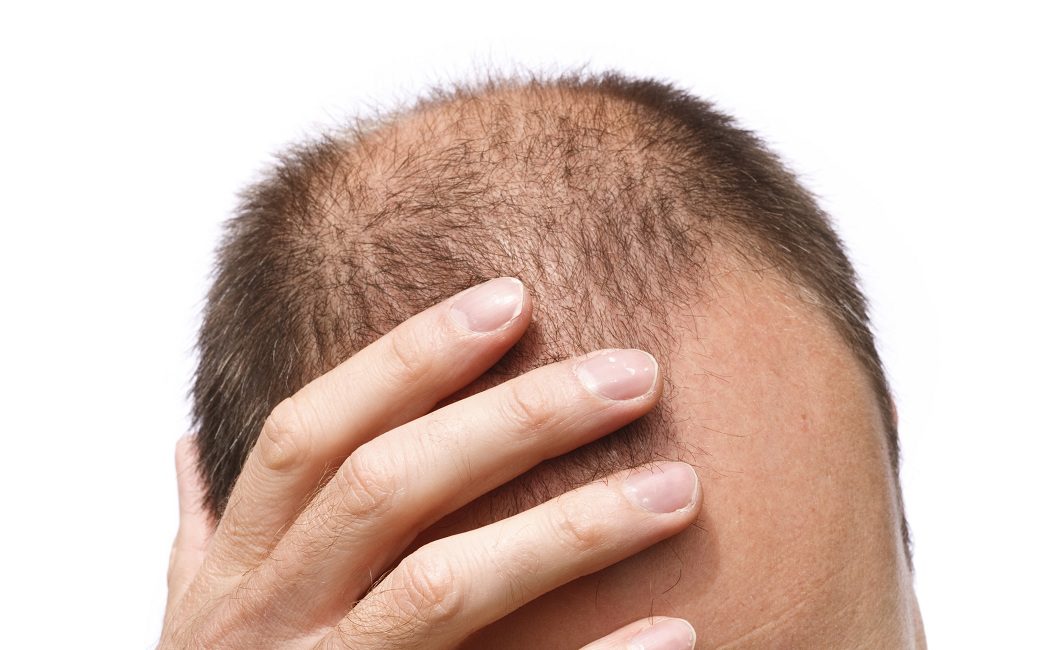 ¿Se puede prevenir la alopecia?