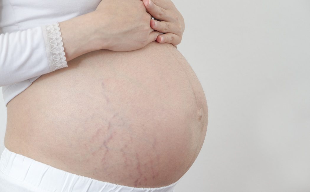 Cómo evitar que salgan las estrías durante el embarazo